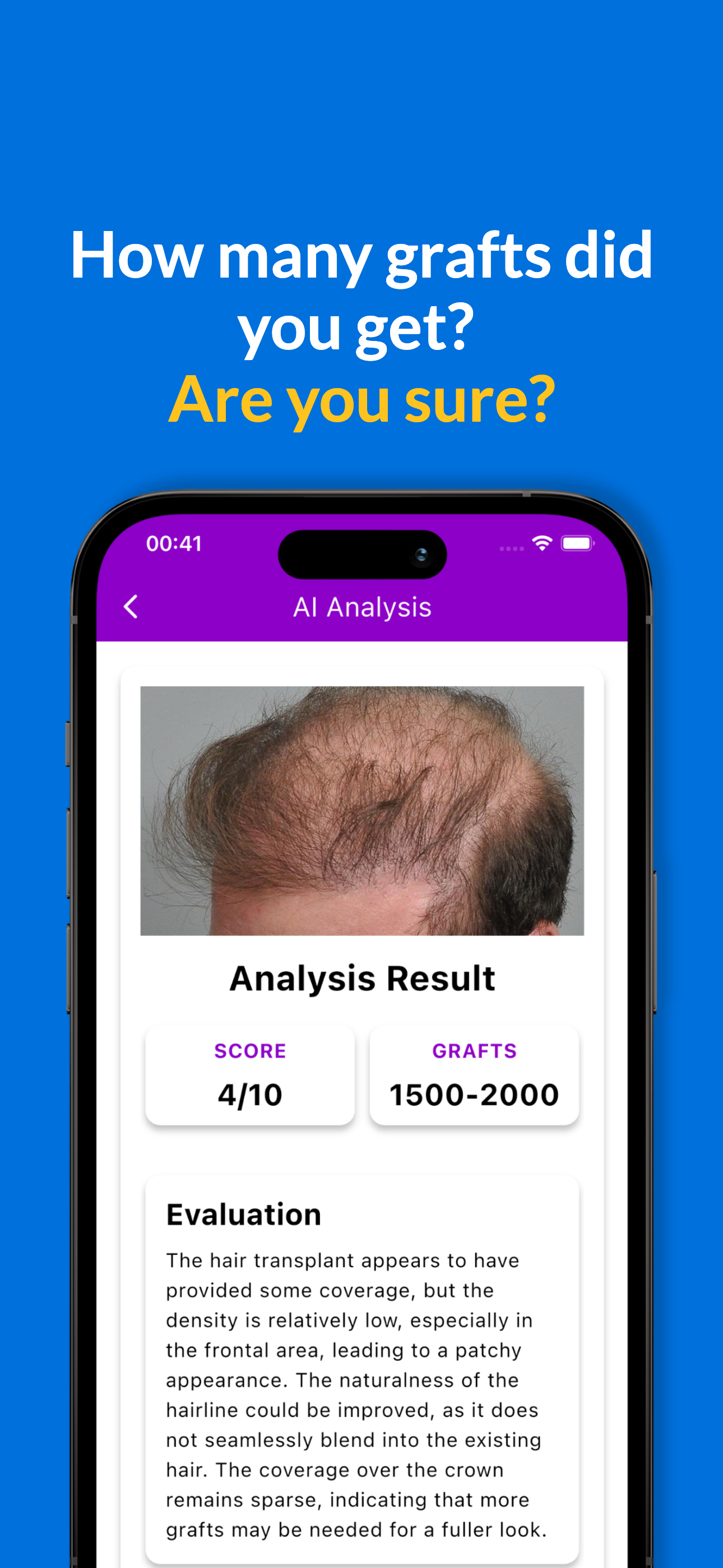 Hair Transplant AI app showing graft analysis report