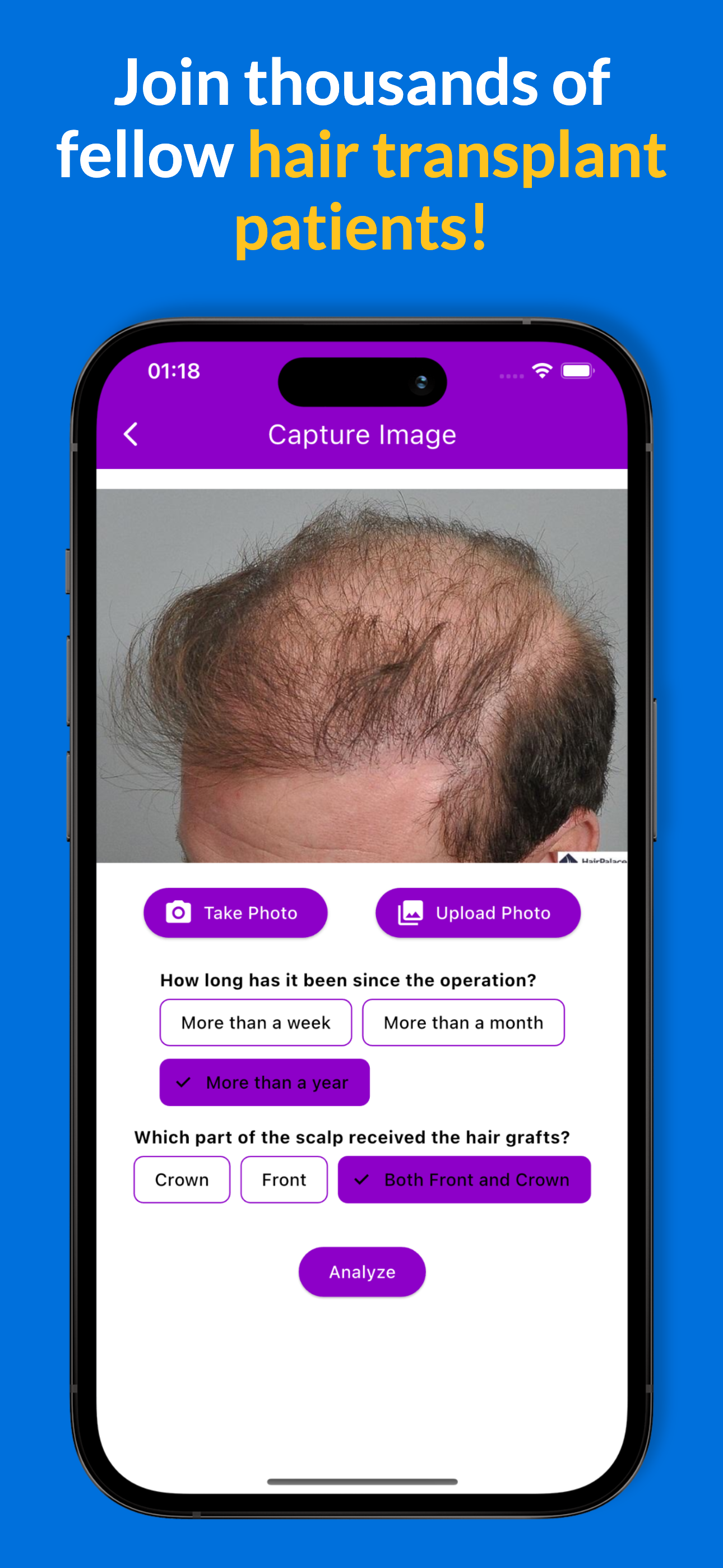 AI scoring system for hair transplant success